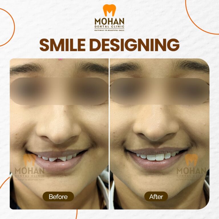 01 MOHAN DENTAL CLINIC - BEFORE AFTER -BROKEN TEETH