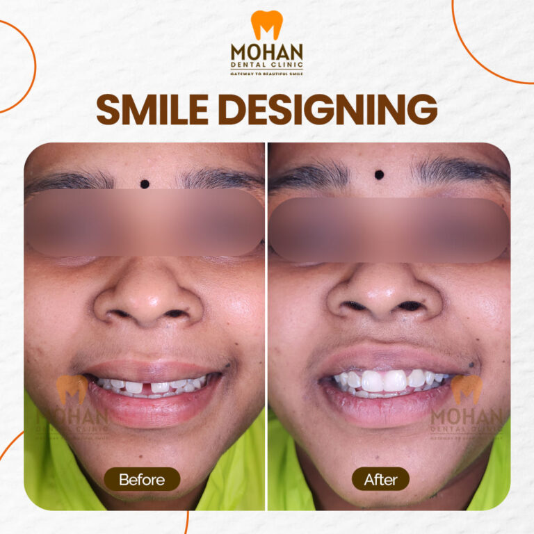 02 MOHAN DENTAL CLINIC - BEFORE AFTER -BROKEN TEETH