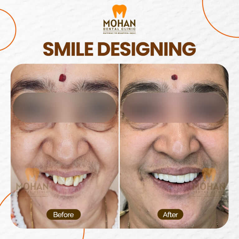 03 MOHAN DENTAL CLINIC - BEFORE AFTER -CROOKED TOOTH