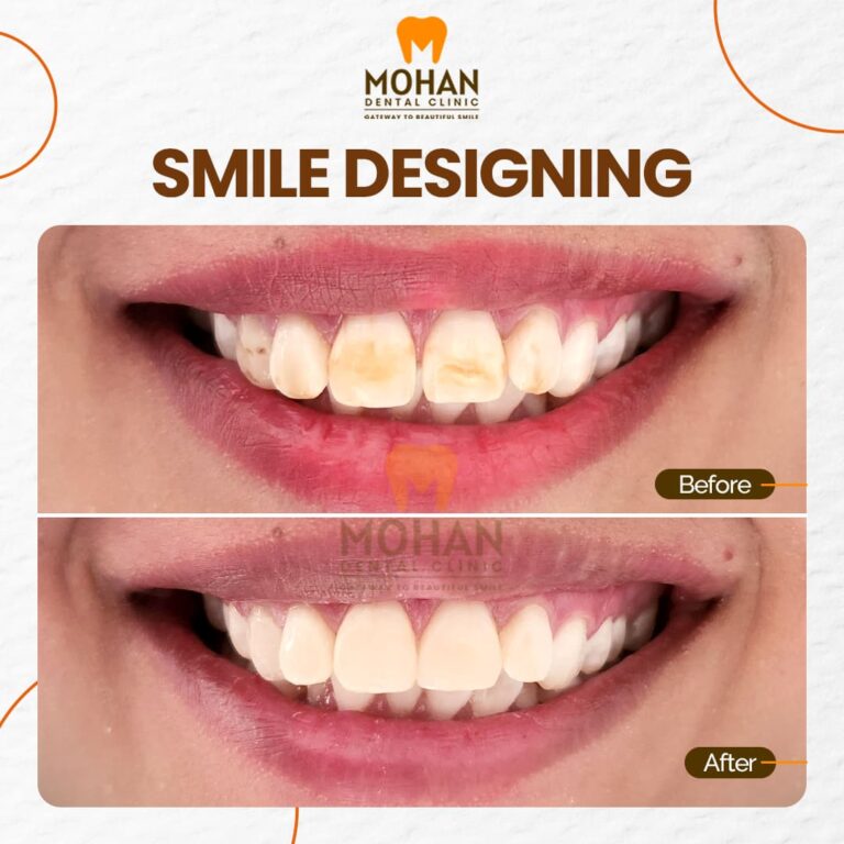 04 MOHAN DENTAL CLINIC - BEFORE AFTER