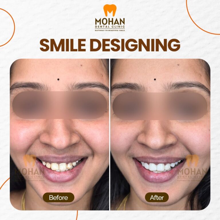 05 MOHAN DENTAL CLINIC - BEFORE AFTER