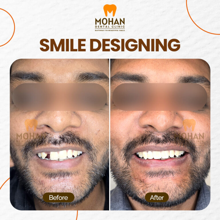 06 MOHAN DENTAL CLINIC - BEFORE AFTER