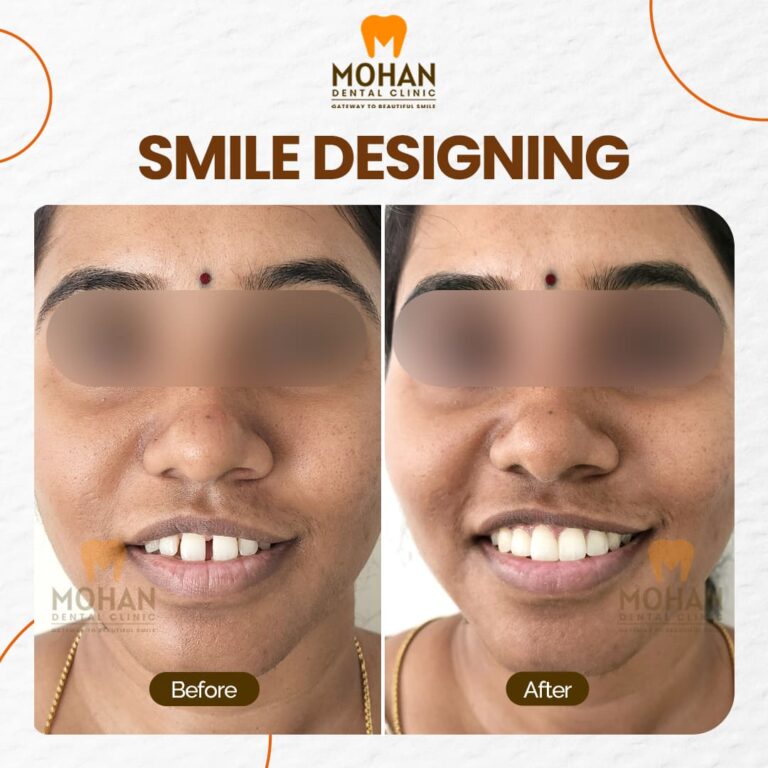 07 MOHAN DENTAL CLINIC - BEFORE AFTER