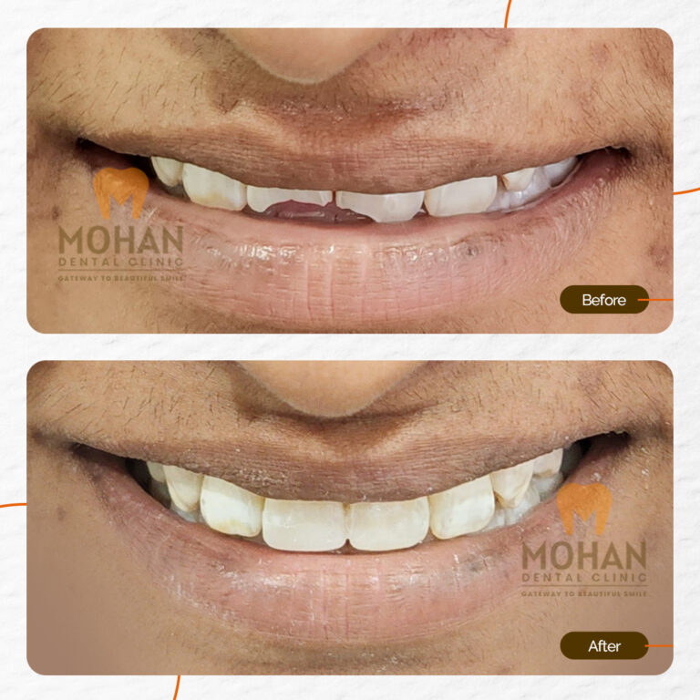 MOHAN DENTAL CLINIC - BROKEN TEETH - 01