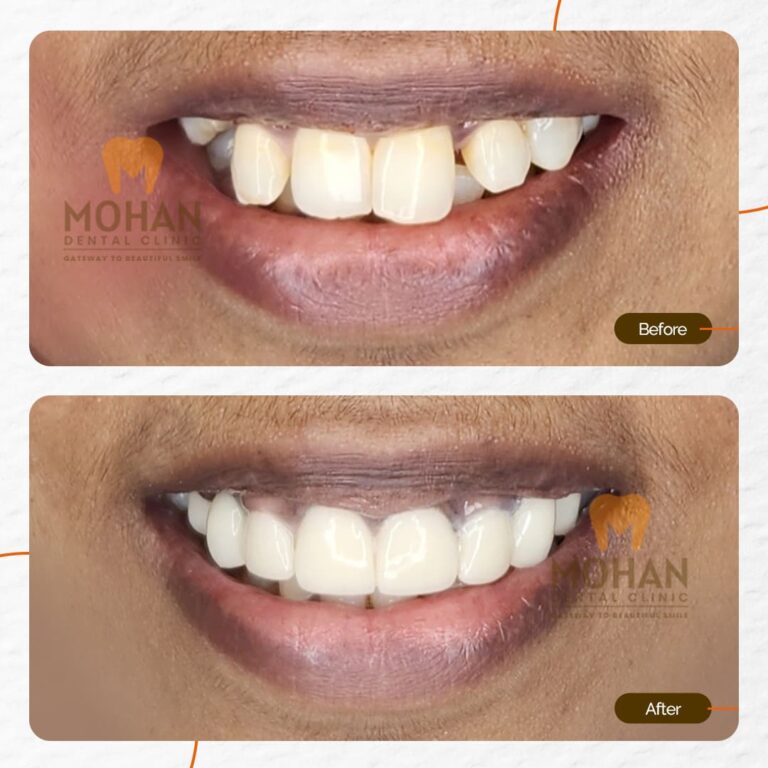 MOHAN DENTAL CLINIC - CROWDED TEETH - 01