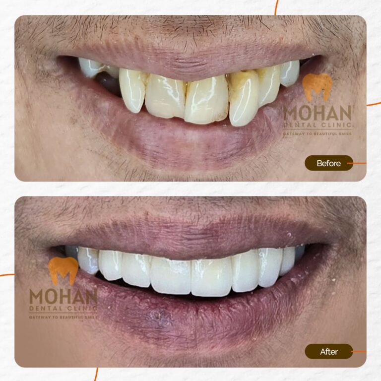 MOHAN DENTAL CLINIC - CROWDED TEETH - 02