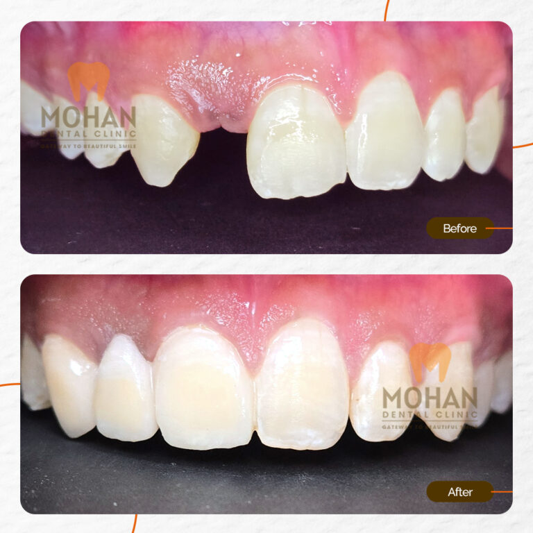 MOHAN DENTAL CLINIC - MISSED TOOTH - 01